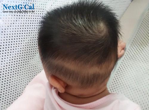 Hình ảnh rụng tóc vành khăn ở trẻ 3 tháng tuổi