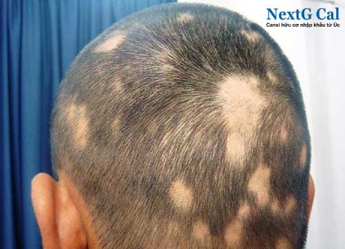 Tự nhiên bị rụng tóc từng mảng là bệnh gì