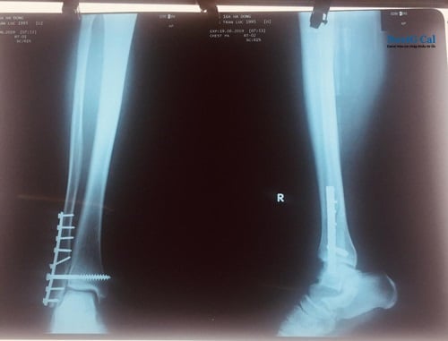 Phẫu thuật gãy xương mác cẳng chân