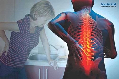 Triệu chứng gãy xương cột sống thắt lưng