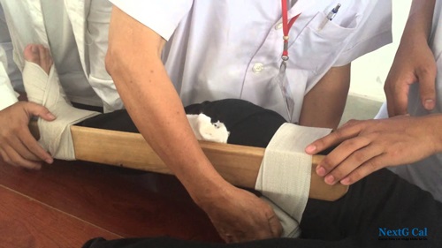 Kỹ thuật sơ cứu gãy xương cẳng chân