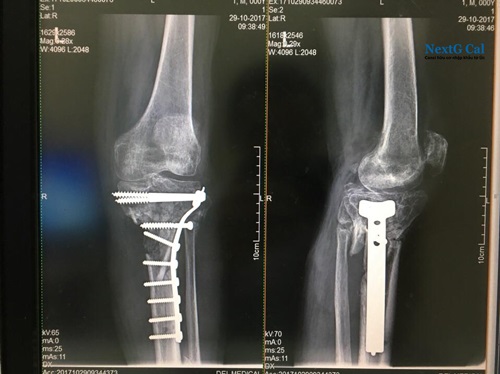 Phẫu thuật gãy xương cẳng chân