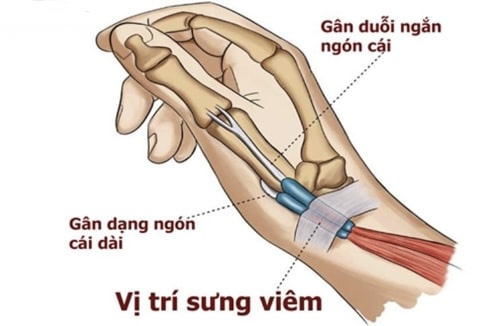 đau khớp cổ tay sau sinh