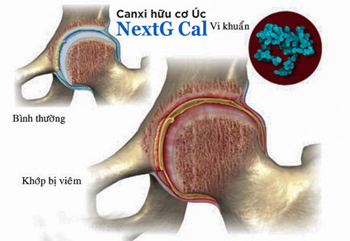 viêm khớp nhiễm khuẩn điều trị