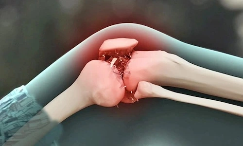 gãy xương nên mổ hay bó bột