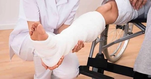 gãy xương có khiến teo cơ không