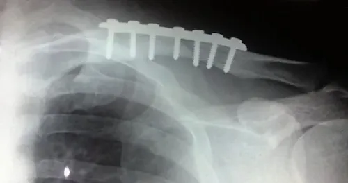 gãy xương chậu bao lâu quan hệ được