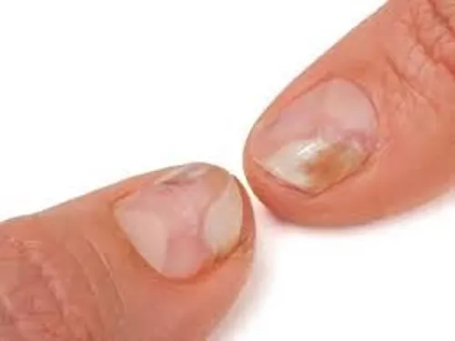 móng tay bị giòn