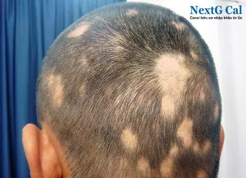 Tự nhiên bị rụng tóc từng mảng là bệnh gì